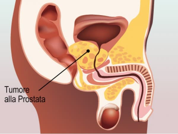 carcinoma-prostata